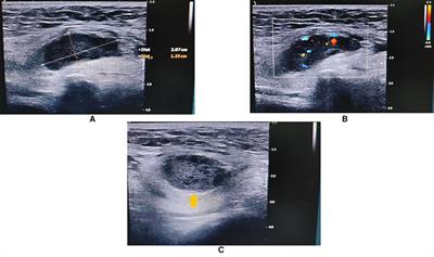 Spermatic cord anastomosing hemangioma mimicking a malignant inguinal tumor: A case report and literature review
